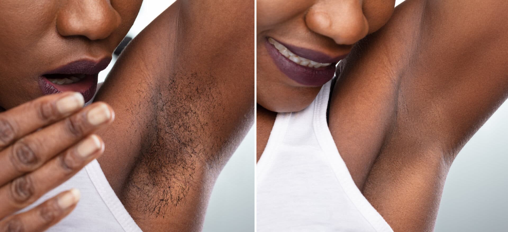 Before and after concept of woman's underarm hair removal